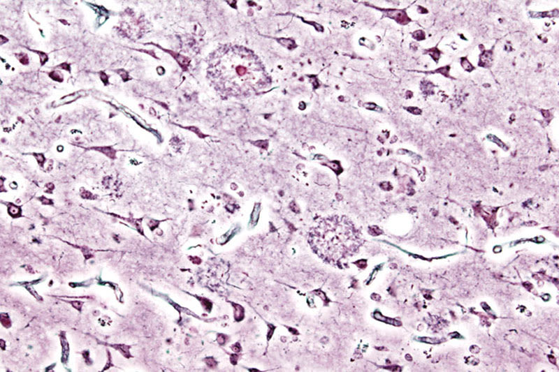 Imagen histopatológica de placas seniles vista en la corteza cerebral de un paciente con la enfermedad de Alzheimer.